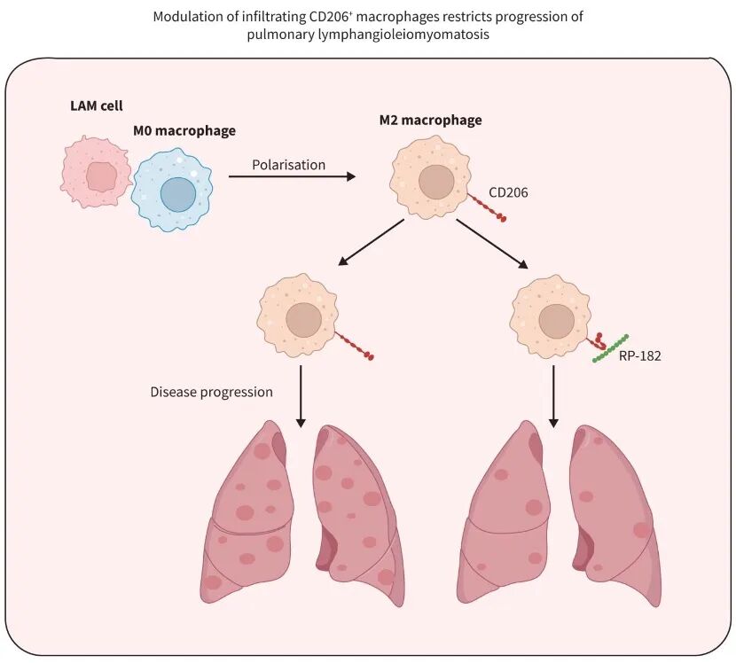 刘恒嘉团队于European Respiratory Journal合作发文，揭示肺淋巴管肌瘤新机制